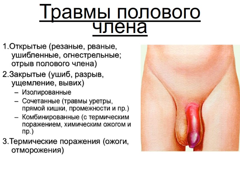 Травмы полового члена 1.Открытые (резаные, рваные, ушибленные, огнестрельные; отрыв полового члена) 2.Закрытые (ушиб, разрыв,